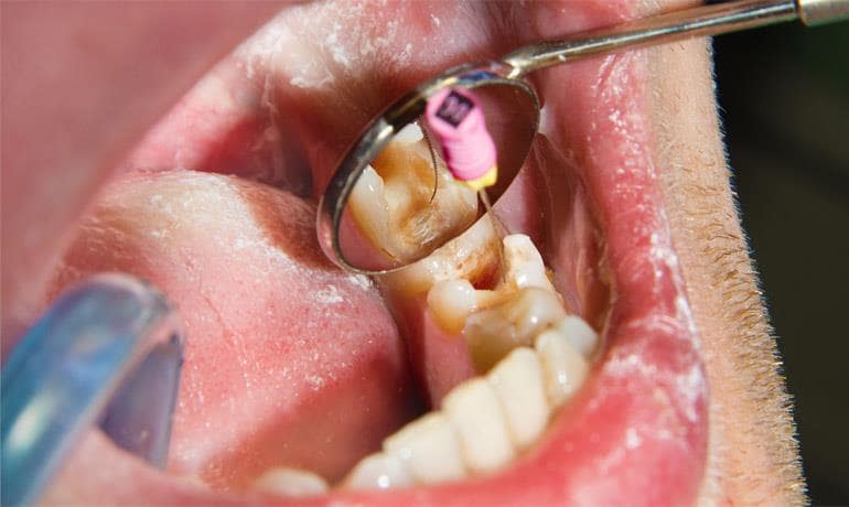 مرکز عصب کشی دندان در تهران